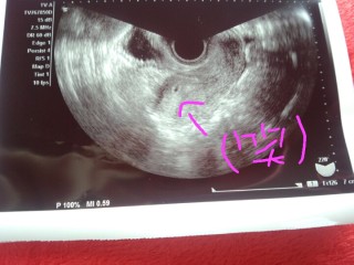 胎嚢 5w0d 妊娠5週(5w4d)で6.3ミリの胎嚢確認！平均よりも胎嚢サイズ小さい？