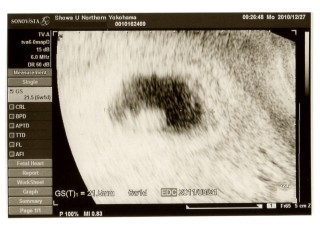 エコー写真