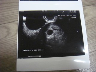 エコー写真
