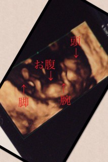 エコー写真