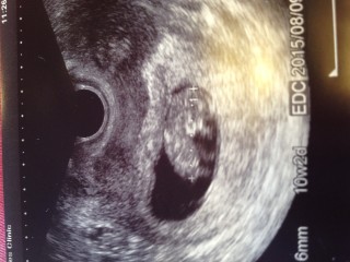 エコー写真