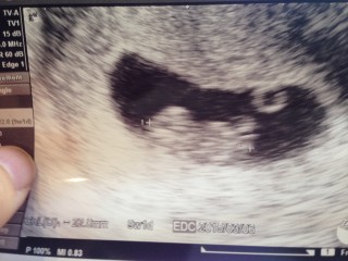 エコー写真