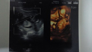 エコー写真