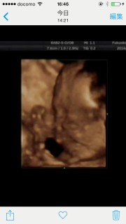 エコー写真