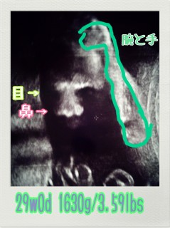エコー写真