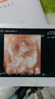 エコー写真