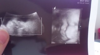 妊娠36週5日 36w5d の超音波 エコー 写真