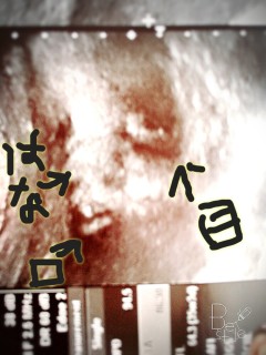 エコー写真