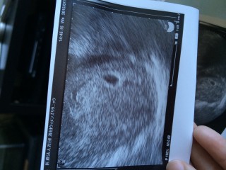 エコー写真
