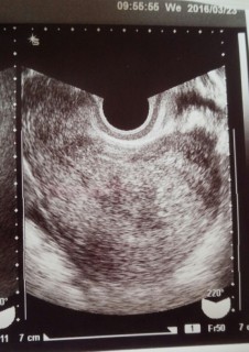 週 ない 5 胎嚢 確率 見え ５週で胎嚢が見えない｜女性の健康 「ジネコ」