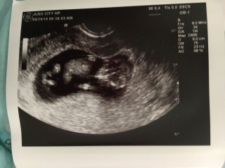 エコー写真