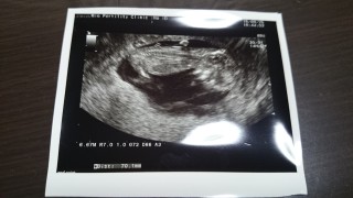 エコー写真