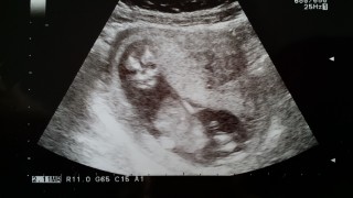 妊娠14週3日 14w3d の超音波 エコー 写真