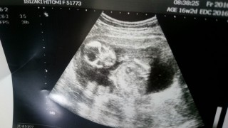妊娠16週2日 16w2d の超音波 エコー 写真
