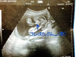 妊娠週6日 w6d の超音波 エコー 写真
