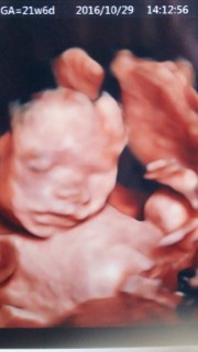 妊娠21週6日 21w6d の超音波 エコー 写真