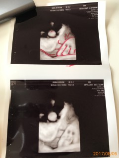 妊娠36週5日 36w5d の超音波 エコー 写真
