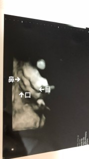 エコー写真