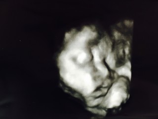 エコー写真