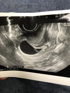 エコー写真