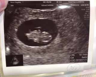 妊娠8週4日 8w4d の超音波 エコー 写真 妊娠8週4日 8w4d の超音波 エコー 写真