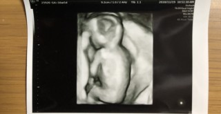 妊娠16週5日 16w5d の超音波 エコー 写真