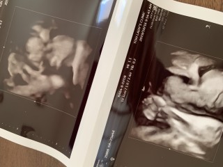 エコー写真