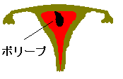 子宮内膜ポリープ