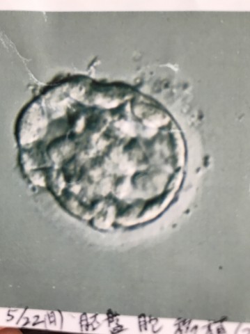 2回目に移植した胚盤胞